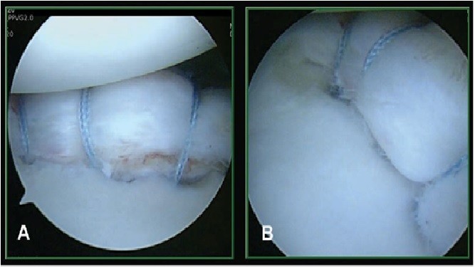 Αρθροσκοπική Bankart repair
Capsular shift  -   Latarjet
