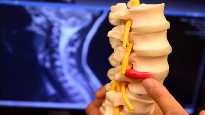 Δισκοκήλη Οσφυικής και Αυχενικής Μοίρας Σπονδυλικής Στήλης