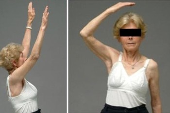 καταγματα εγγυς ή ανω περατος βραχιονιου οστου