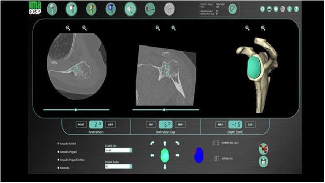 Ολική αρθροπλαστική ώμου με το καινοτόμο Blueprint