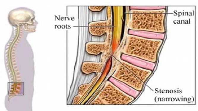 Οσφυική Σπονδυλική Στένωση