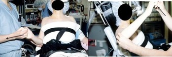 παγωμενος ωμος συμφυτικη θυλακιτιδα