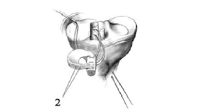 Ρήξη μηνίσκου
